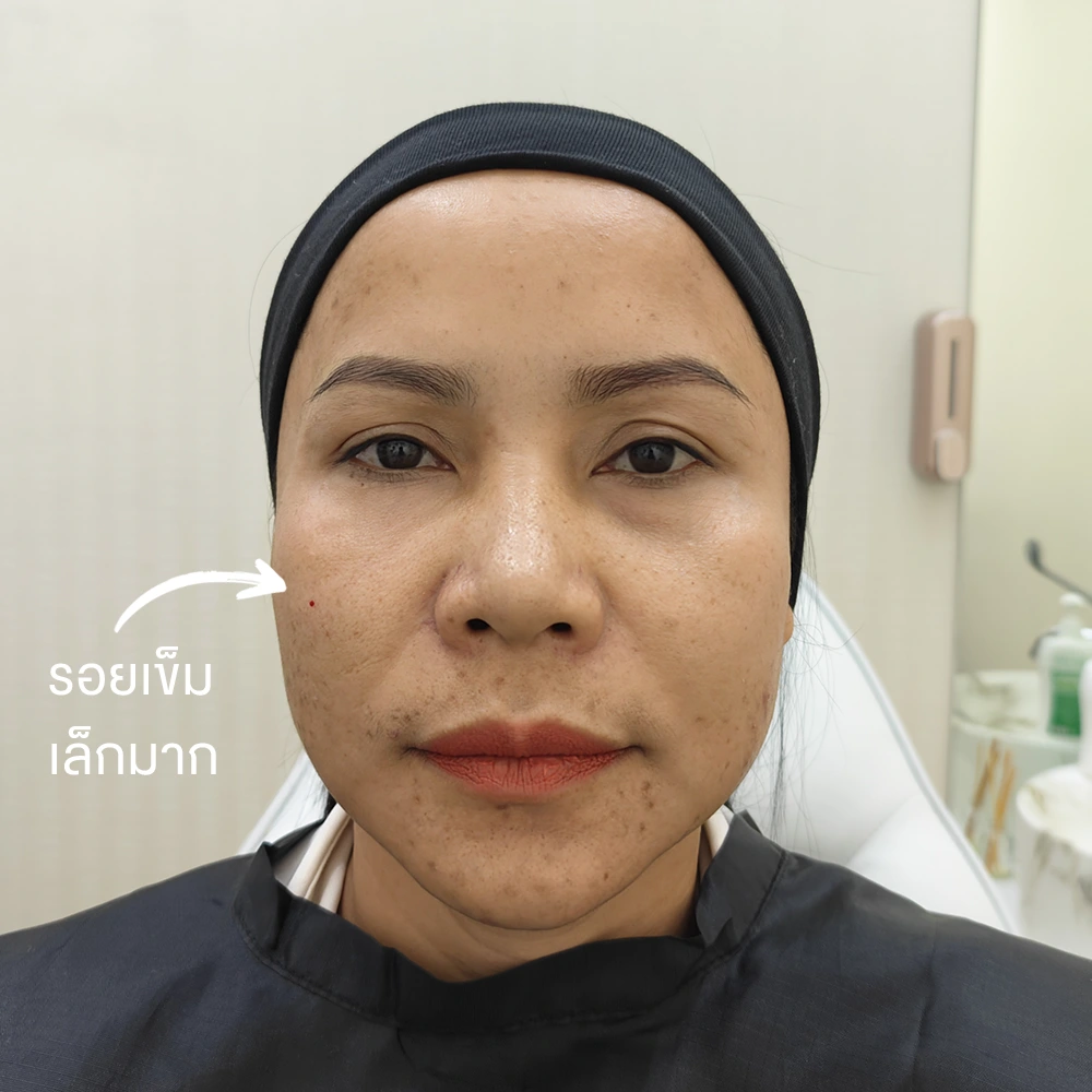 ฉีดฟิลเลอร์ใต้ตา ใช้กี่ CC 1CC เยอะแค่ไหน เจ็บไหม ฉีดที่ไหนดี