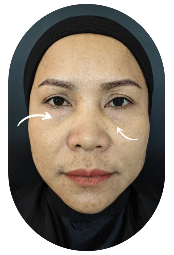 Before and after photos: Acne treatment, under-eye filler injection, Dr. Tar, case 57, Dlovevery Clinic.