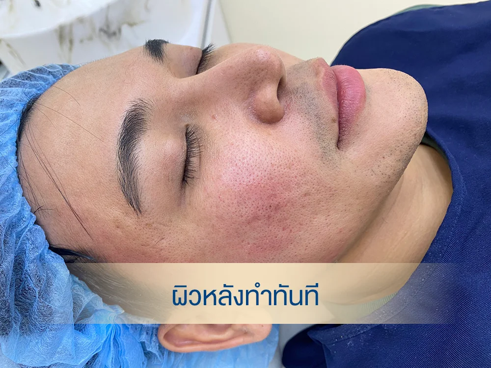ภาพเคสรีวิวหน้ารีวิว scuptra หลังทำ หน้าเป็นยังไง