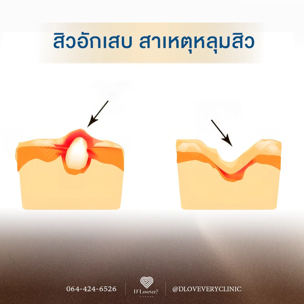 สิวอักเสบ คือต้นตอ สาเหตุของการเป็นหลุมสิว คลินิกรักษาหลุมสิว