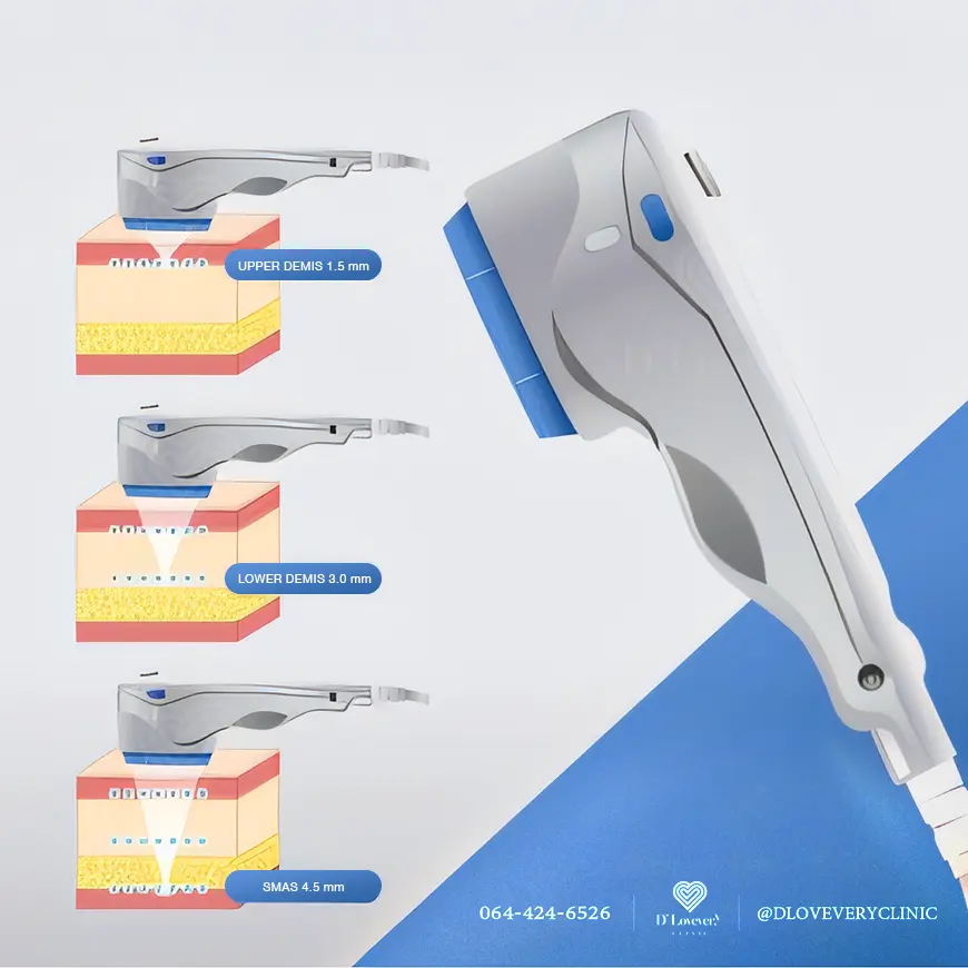 หัว hifu ulthera ส่งพลังงานลงลึก ถึงชั้นผิวที่หย่อนคล้อย