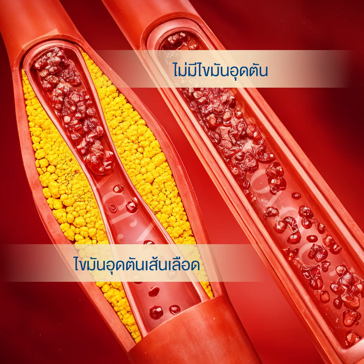 Fat buildup in blood vessels, health check-up, health check-up package.
