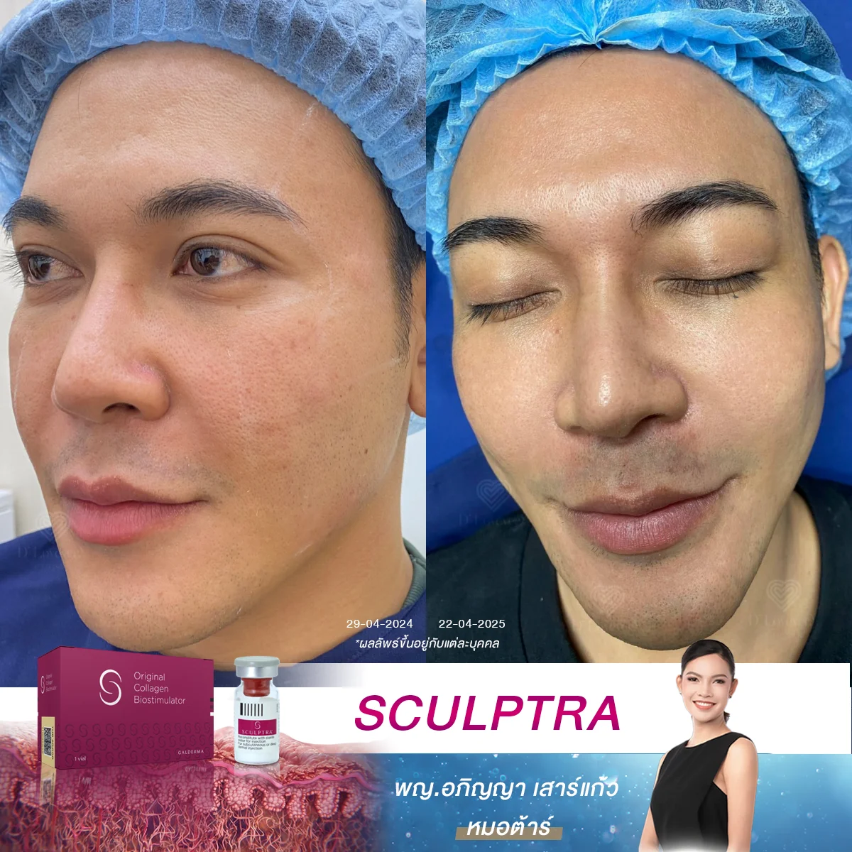 เปิดประสบการณ์ใหม่ของคุณผู้ชายยุคนี้ ให้หน้าแน่นกระชับด้วย Sculptra