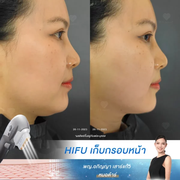 hifu ที่อื่นบอกไม่จำกัดช็อต แต่ไม่เห็นผล ที่นี่บอกว่า “ไม่เน้นช็อต เน้นผลลัพธ์