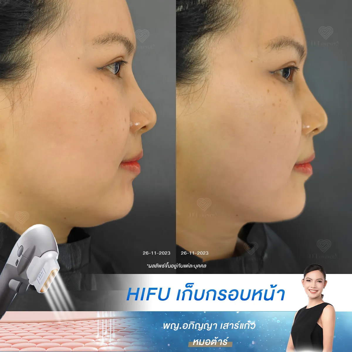 hifu ที่อื่นบอกไม่จำกัดช็อต แต่ไม่เห็นผล ที่นี่บอกว่า “ไม่เน้นช็อต เน้นผลลัพธ์