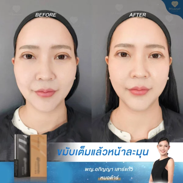 รีวิว ก่อนทำ หลังทำ ฉีดฟิลเลอร์ขมับ ด้วยฟิลเลอร์เกาหลี Neuramis dlovevery clinic
