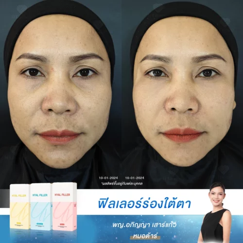 รีวิวแก้ปัญหาสิว รอยสิว และร่องใต้ตาดำคล้ำ เปลี่ยนตัวเองให้มั่นใจที่ D' Lovevery Clinic