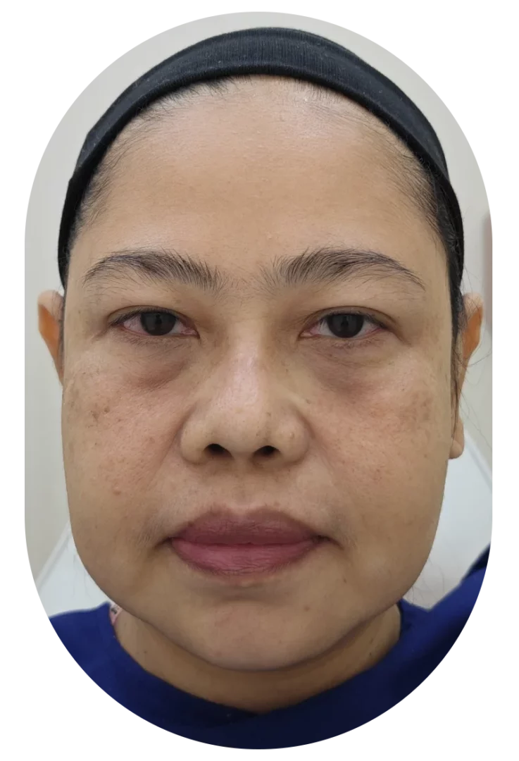 Before picture: Under-eye filler injection to correct under-eye bags and create a smooth, even complexion. Immediately after picture.