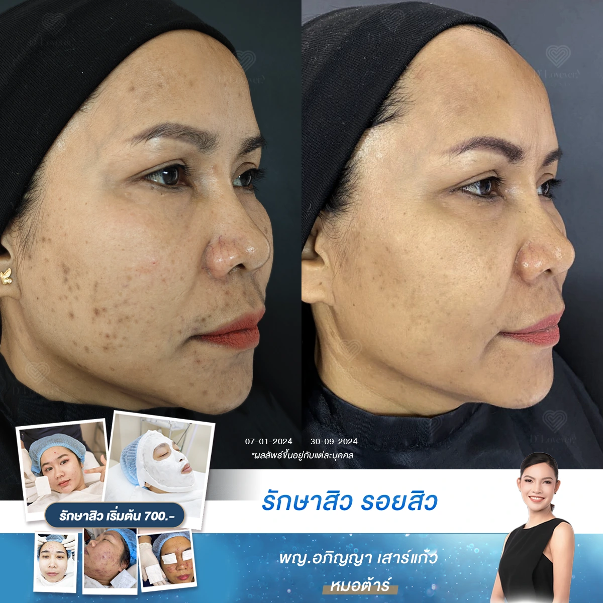 รีวิวแก้ปัญหาสิว รอยสิว และร่องใต้ตาดำคล้ำ เปลี่ยนตัวเองให้มั่นใจที่ D' Lovevery Clinic