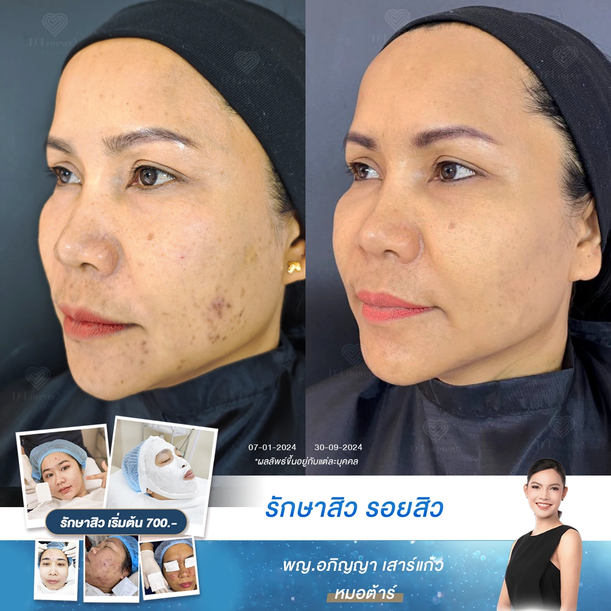 รีวิวแก้ปัญหาสิว รอยสิว และร่องใต้ตาดำคล้ำ เปลี่ยนตัวเองให้มั่นใจที่ D' Lovevery Clinic