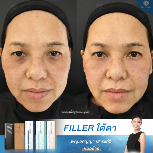 รีวิวลูกค้า ฉีดฟิลเลอร์ใต้ตา กับหมอต้าร์ ลบร่องลึก เรียบเนียนในวันเดียว
