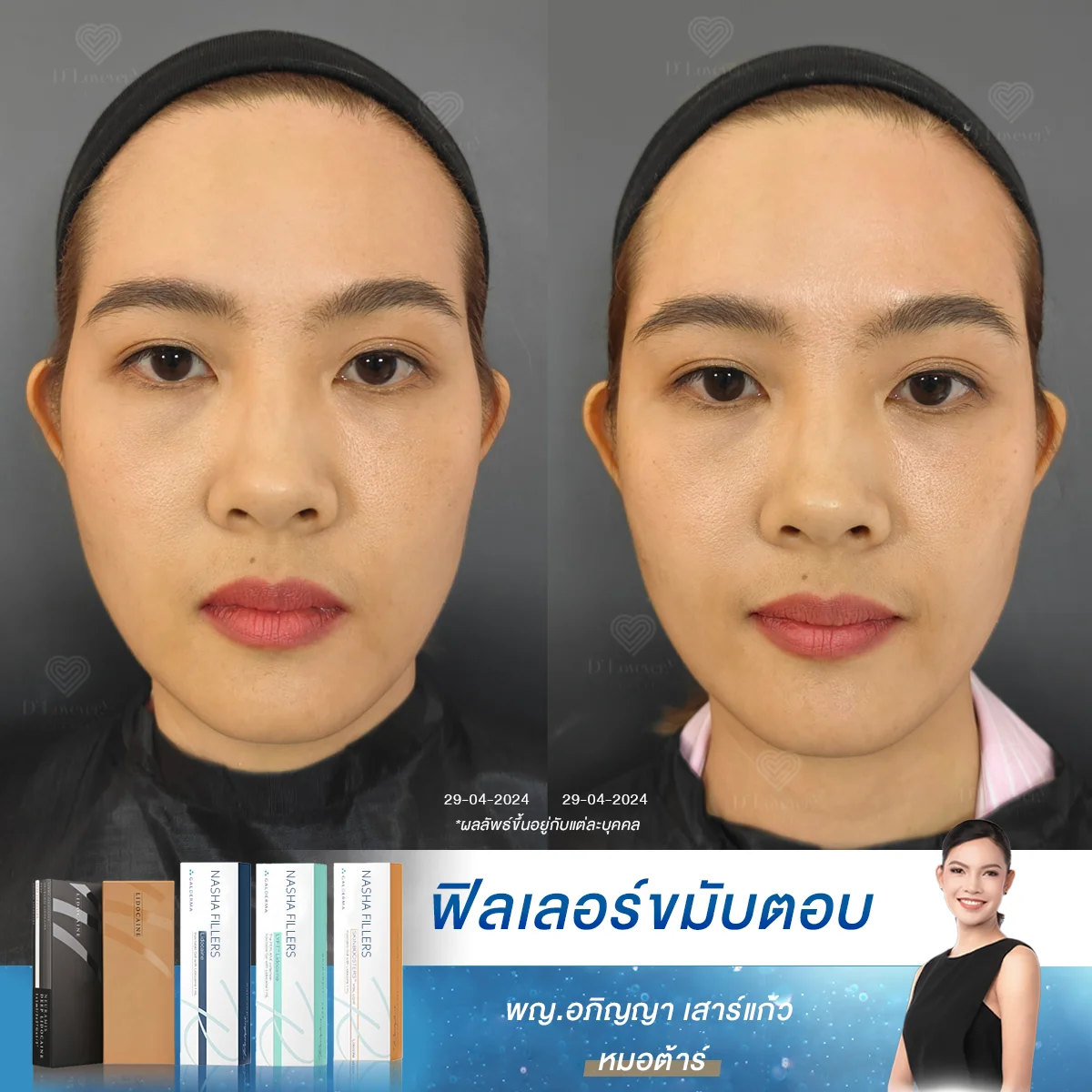 แก้ปัญหาขมับตอบ ด้วยเทคนิคเติมวอลลุ่มที่ D' Lovevery Clinic