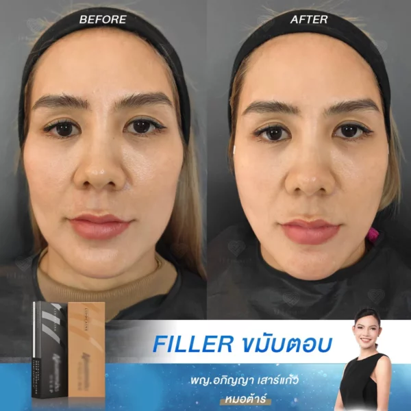 ฟิลเลอร์ที่เหมาะสำหรับการเติมเต็มบริเวณขมับและแก้มตอบ