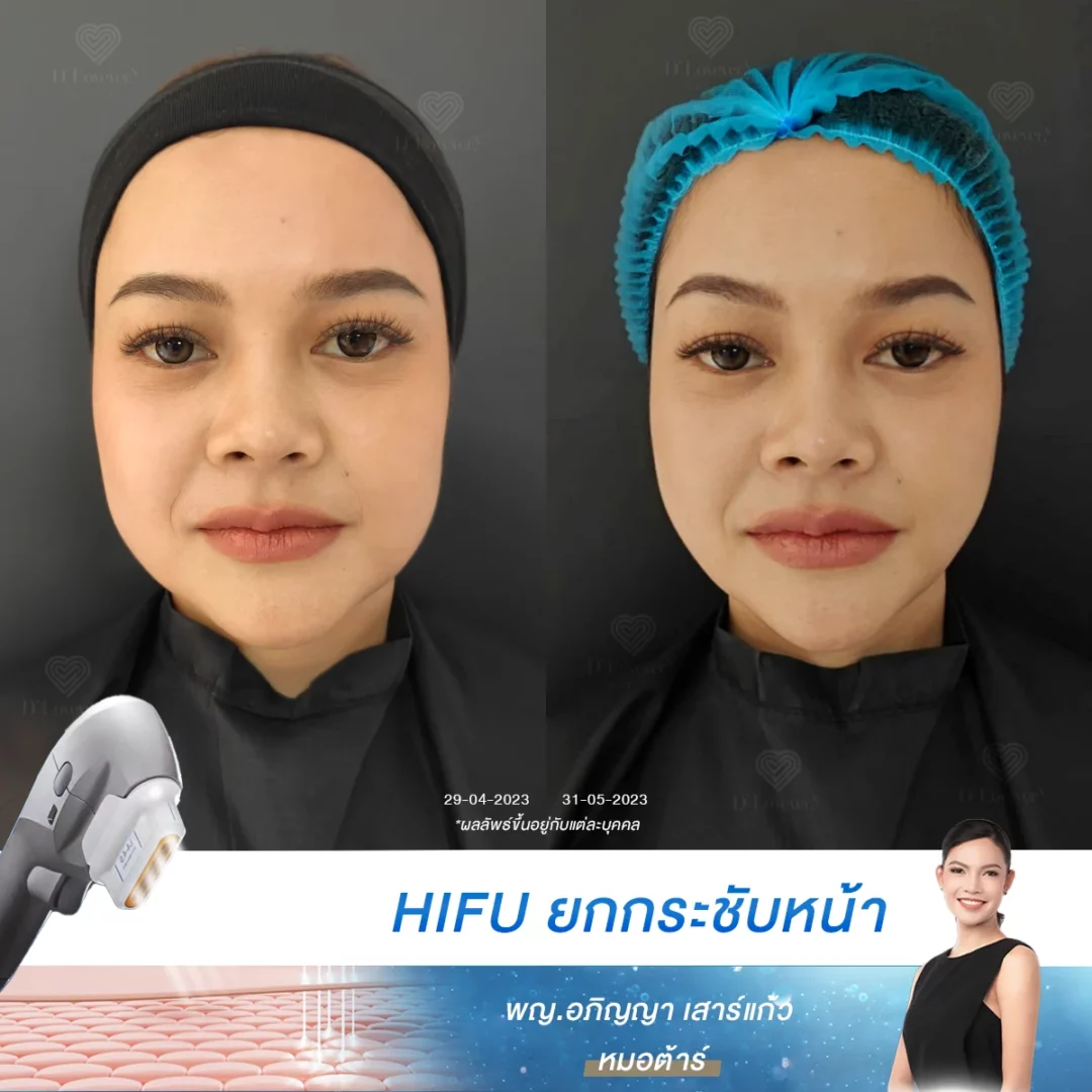 กระเปาะแก้มห้อย จนหน้าดูกลมไม่มีมิติ แก้ไขได้ด้วย HIFU