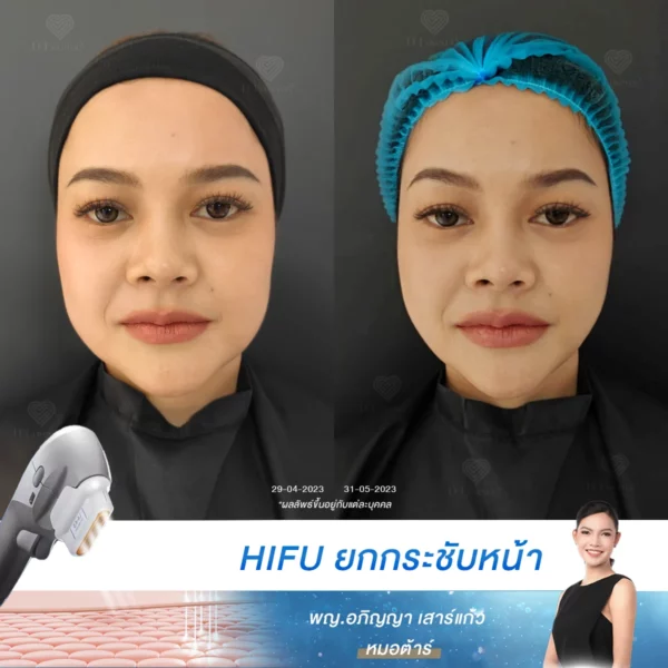 กระเปาะแก้มห้อย จนหน้าดูกลมไม่มีมิติ แก้ไขได้ด้วย HIFU