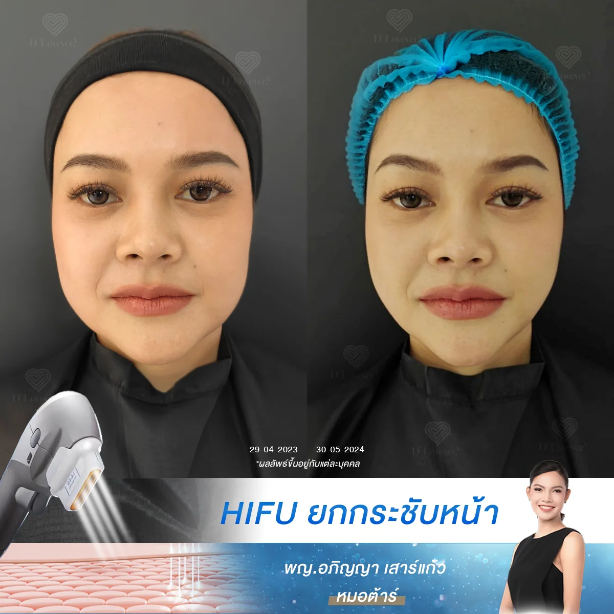 กระเปาะแก้มห้อย จนหน้าดูกลมไม่มีมิติ แก้ไขได้ด้วย HIFU