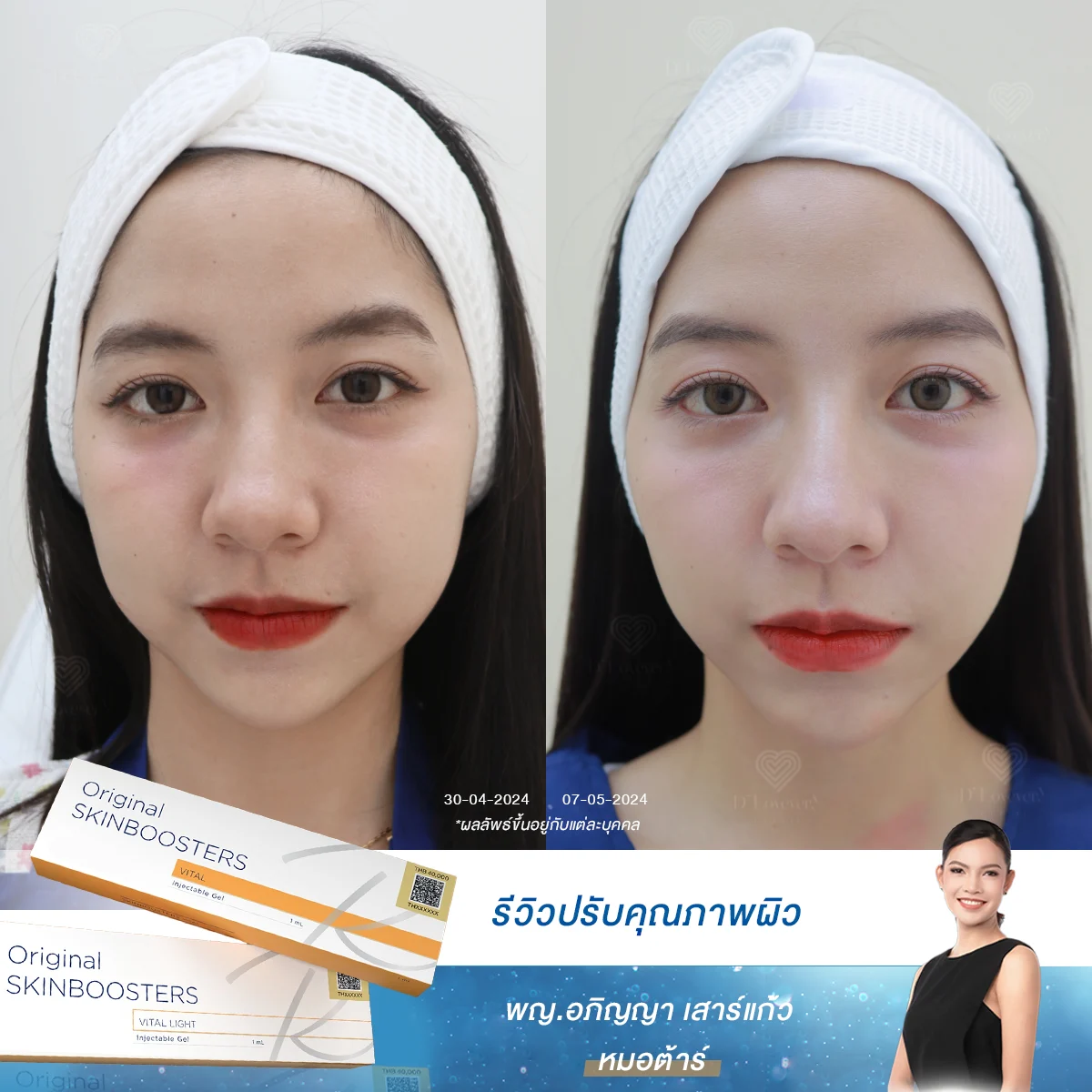 เคล็ด (ไม่) ลับผิวออร่า! คุณผู้หญิงก็มีผิวสวยใสได้ แค่เติม Skinbooster และ Growth Factor กับหมอต้าร์