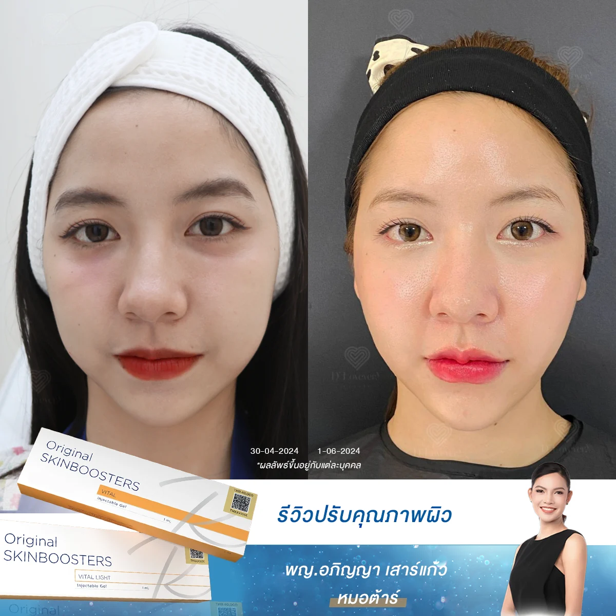 หน้าสดก็รอด! เผยผิวฉ่ำโกลว์ ดุจสาวเกาหลี ด้วย Skinbooster ที่ D’ Lovevery Clinic