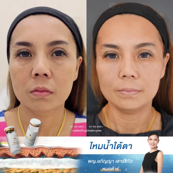 ไหมน้ำฉีดใต้ตา ช่วยเรื่องอะไรบ้าง
