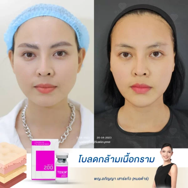 เปิดรีวิวที่จริงใจ หน้าเรียว V-Shape ขึ้น ลดกรามด้วยโบท็อกซ์