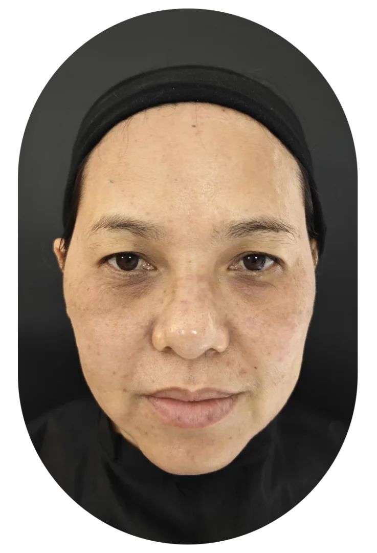 ฟิลเลอร์ใต้ตา เป็นการฉีดสารไฮยาลูโรนิค แอซิด (Hyaluronic Acid)