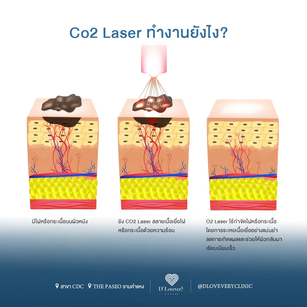 co2 laser ทำงานอย่างไร ราคาเท่าไหร่ จี้ไฝ จี้กระเนื้อ จี้ขี้แมลงวัน