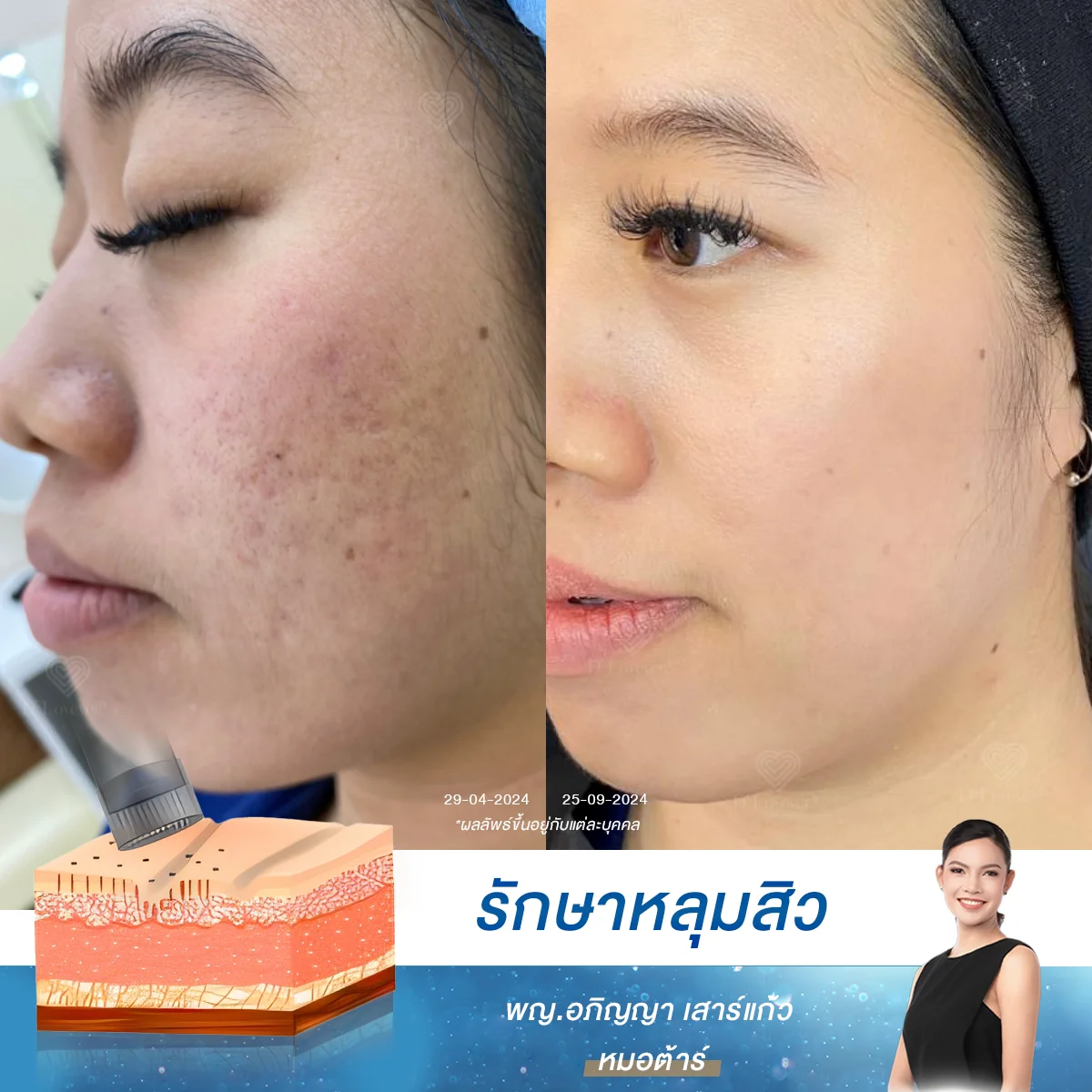 รีวิวฟื้นฟูหลุมสิว Rolling ด้วย Microneedling และ Growth Factor ที่ D' Lovevery Clinic ประสบการณ์ตรง คุณผู้หญิงอายุ 20 ต้นๆ