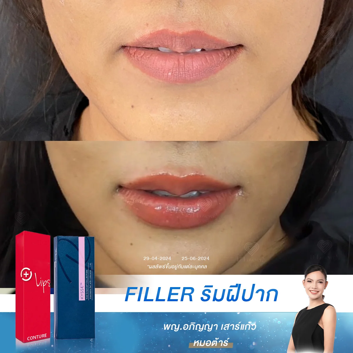 เปลี่ยนปากบางเป็นปากสวยอวบอิ่ม คืนความมั่นใจให้รอยยิ้ม ด้วยฟิลเลอร์ปากที่ D’ Lovevery Clinic