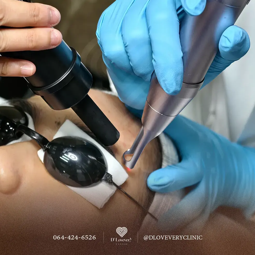 pico laser dlovevery clinic ราคาเท่าไหร่