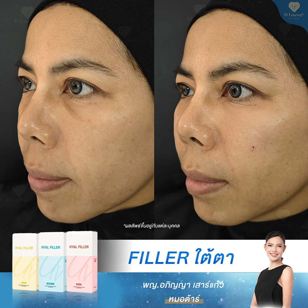 ultra v hyal filler รีวิว ฉีดใต้ตาคล้ำ ลึก หมอต้าร์ dlovevery clinic