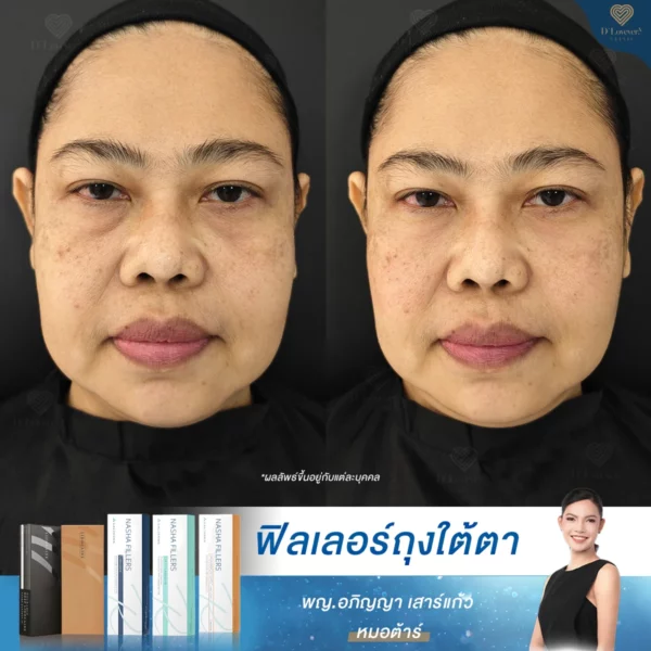 ฉีดฟิลเลอร์ใต้ตา แก้ถุงใต้ตา ใต้ตาลึกไม่เท่ากัน หมอต้าร์ dlovevery clinic-2