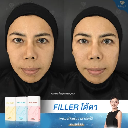 หัวตาคล้ำ ใต้ตาคล้ำ ทำยังไง ฉีดฟิลเลอร์ที่ดี