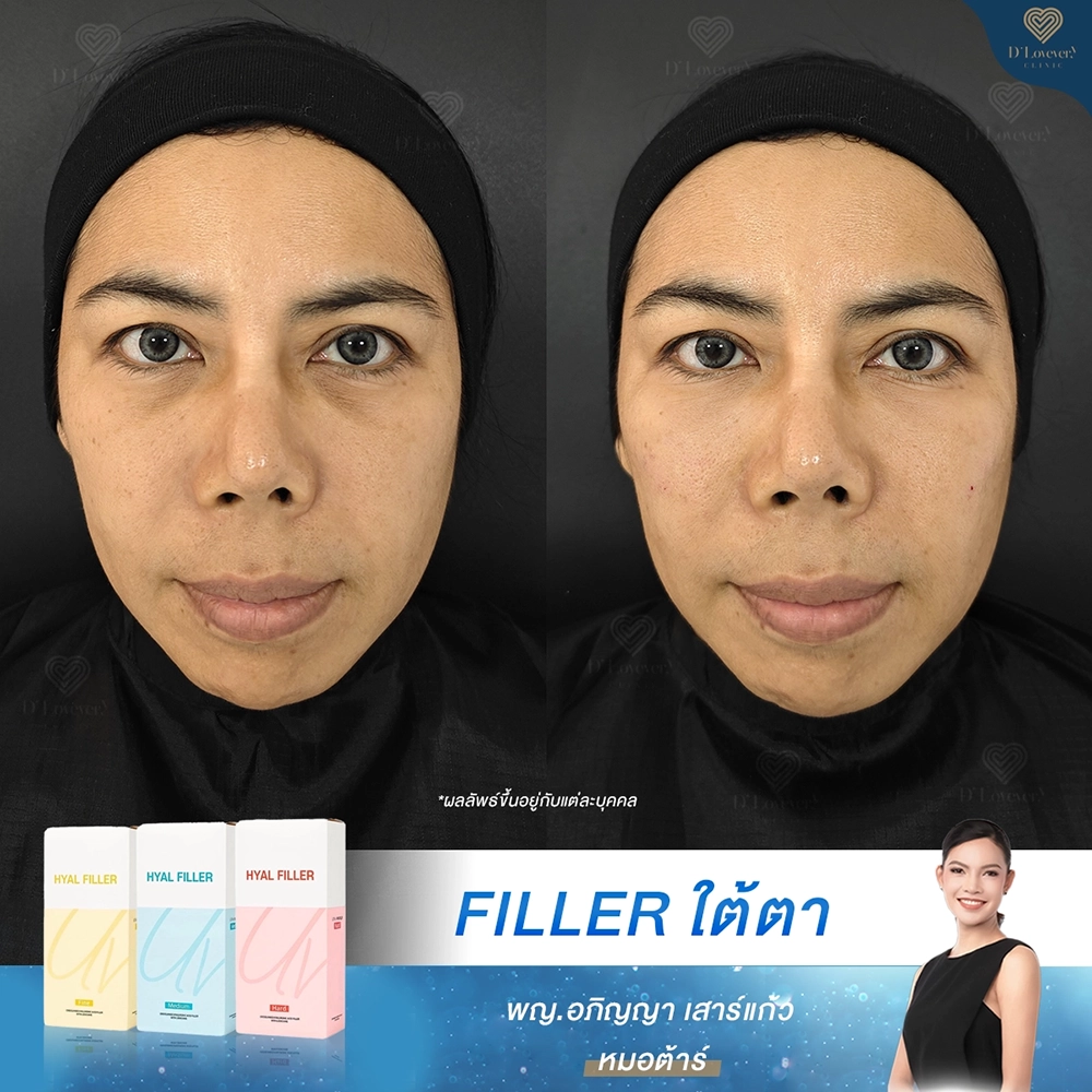 ฉีดฟิลเลอร์ รีวิวแก้ร่องหัวตาคล้ำ สู่ผิวเรียบเนียนดูดี