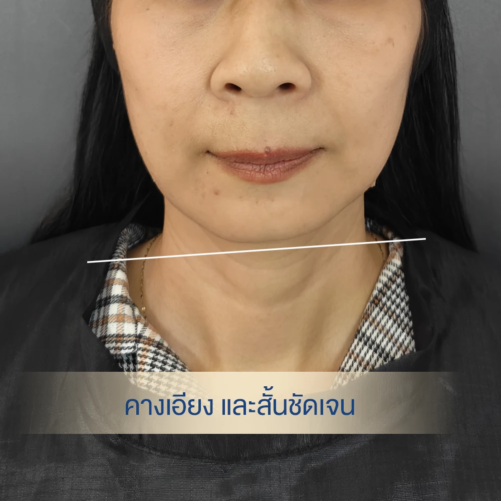 คางเอียง คางเฉียง แก้ไขยังไงได้บ้าง หมอต้าร์ dlovevery clinic