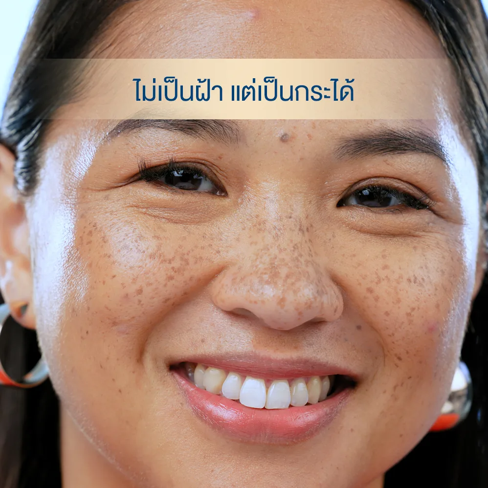 กระ มักพบได้ที่ปลายจมูก สันจมูก โหนกแก้ม หรือหน้าผาก—เพราะเป็นบริเวณที่โดนแดดโดยตรง