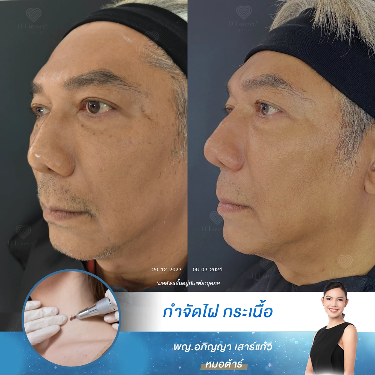 Multiple skin tags can be removed. Complete service at D'Lovevery Clinic.