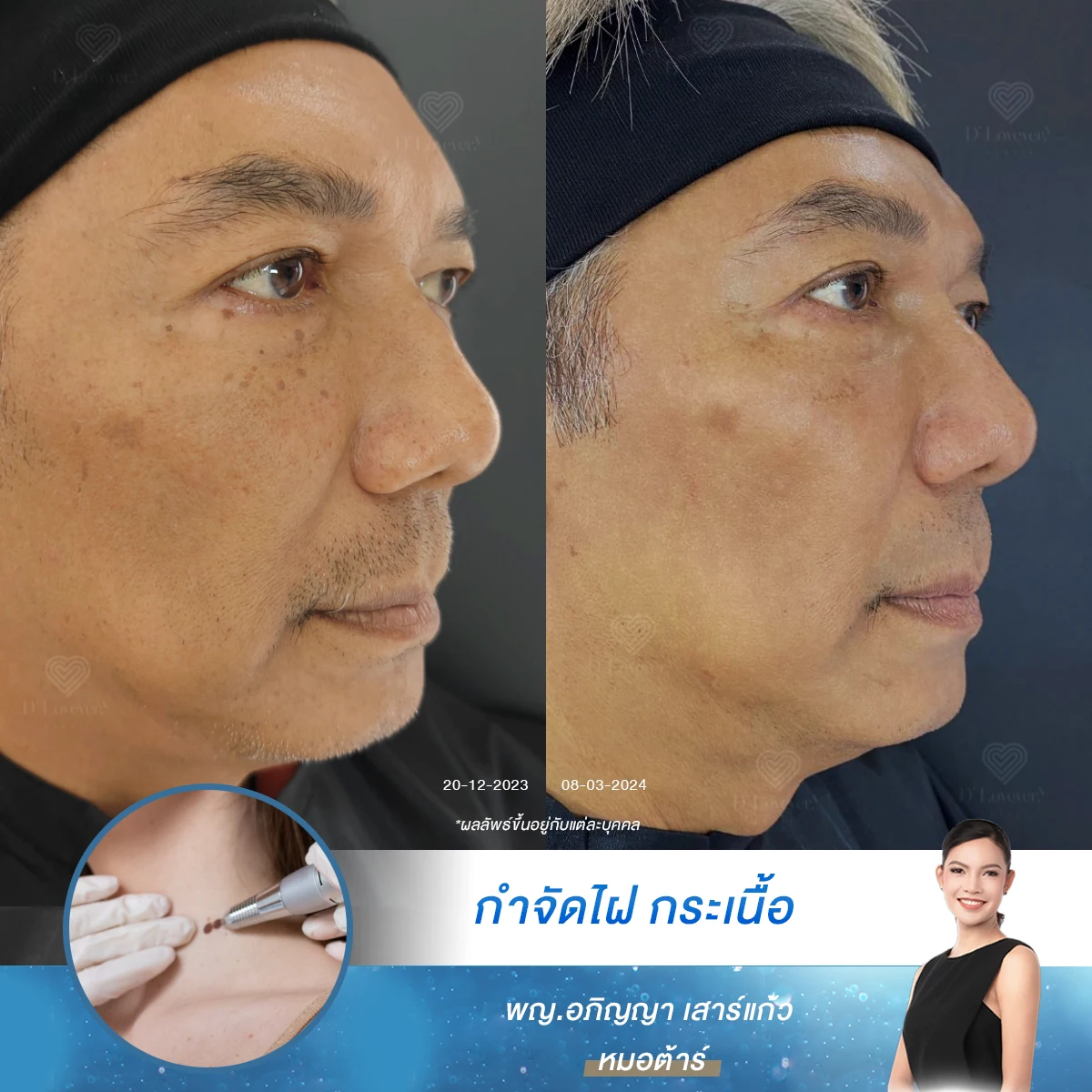 Multiple skin tags can be removed. Complete service at D'Lovevery Clinic.