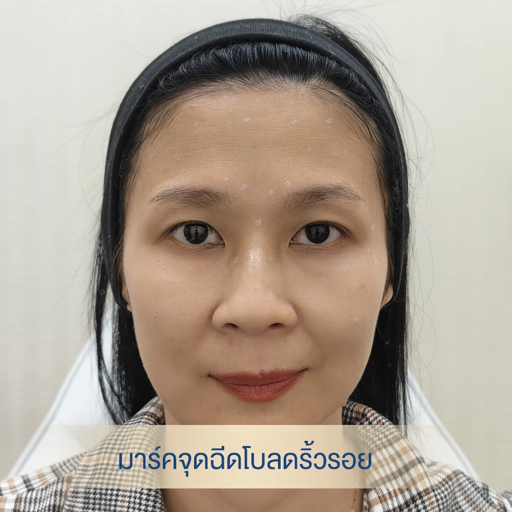 ฉีดลดริ้วรอย หน้าผาก หางตา หว่างคิ้ว โบท็อกซ์ หมอต้าร์ ราคา 4999