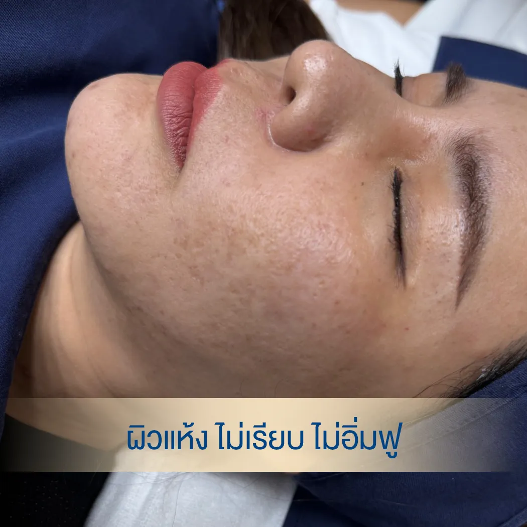ผิวเนียนขึ้นด้วย rejuran-รีจูรัน ผิวอิ่มฟู ราคา