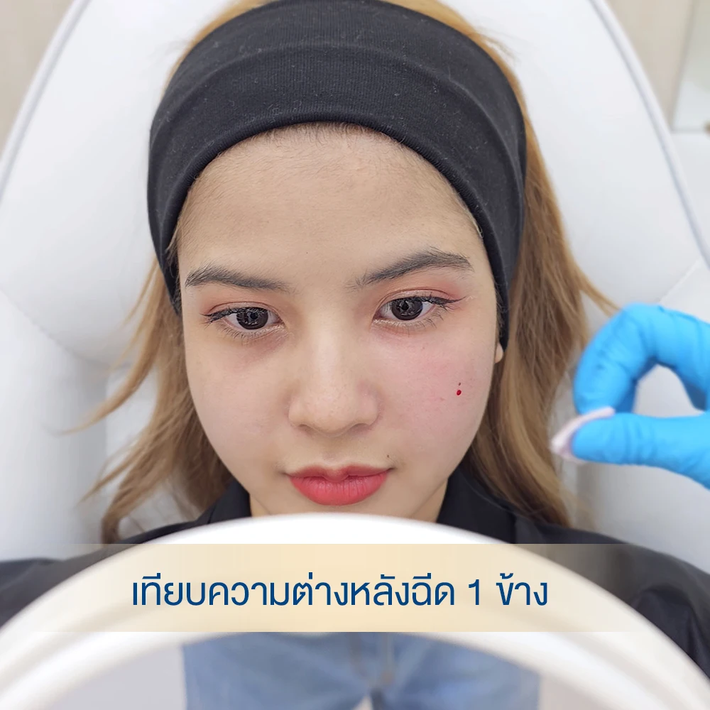 ภาพเคสรีวิว 66 ฟิลเลอร์ใต้ตา เห็นผลทันที ดีเลิฟเวอรี่คลินิก หมอต้าร์ แ