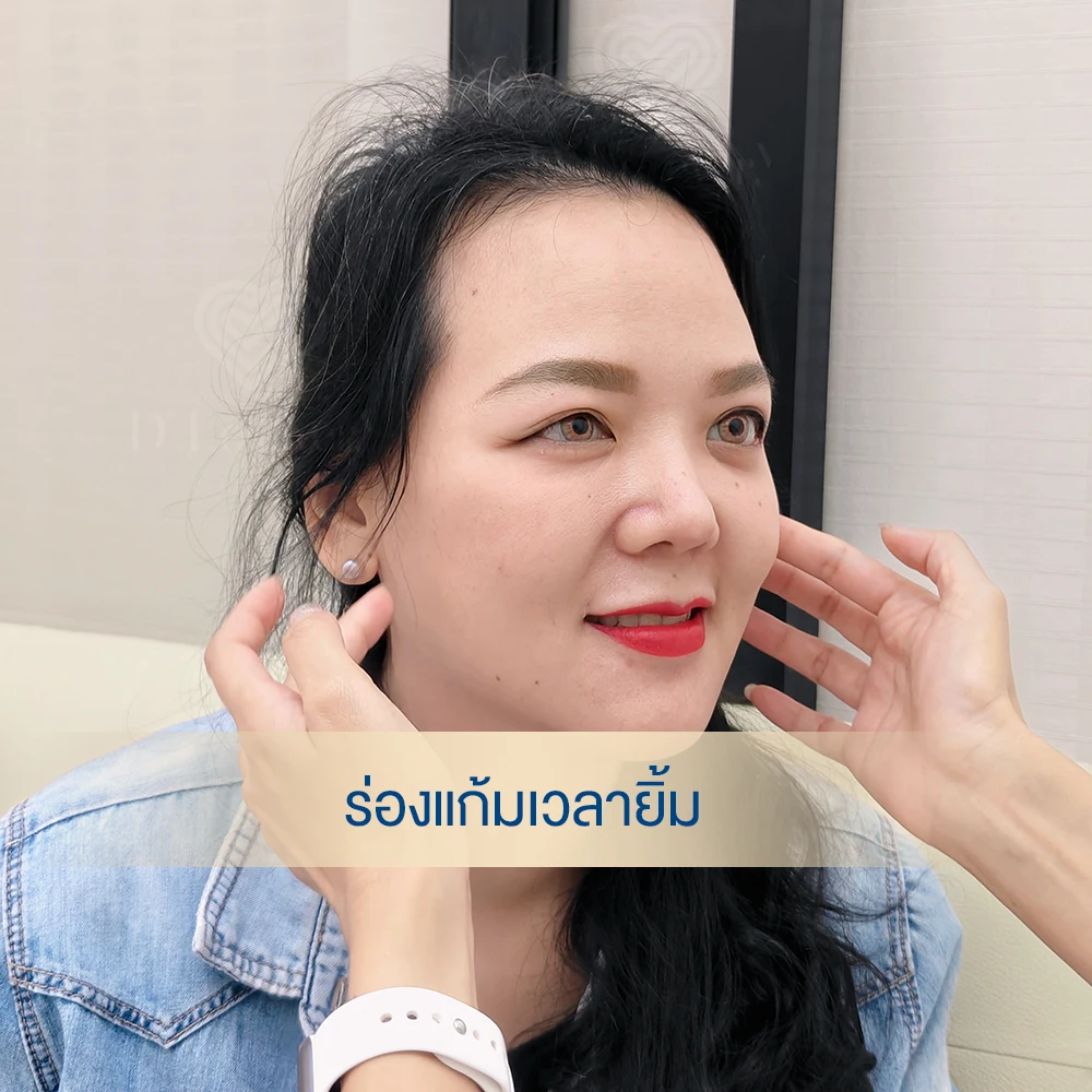 มีร่องแก้ม เวลายิ้ม ทำยังไงดี ฟิลเลอร์ตัวไหนดี