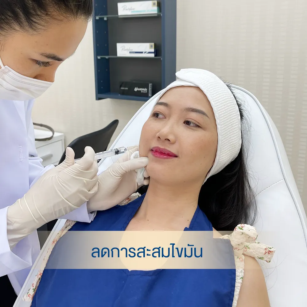 รีวิวจากเคสจริง ฉีดแฟต ก่อนทำ รีวิวฉีดแฟตแก้ม ลดไขมันสะสม