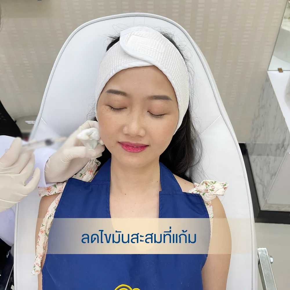 รีวิวจากเคสจริง ฉีดแฟต ก่อนทำ รีวิวฉีดแฟตแก้ม