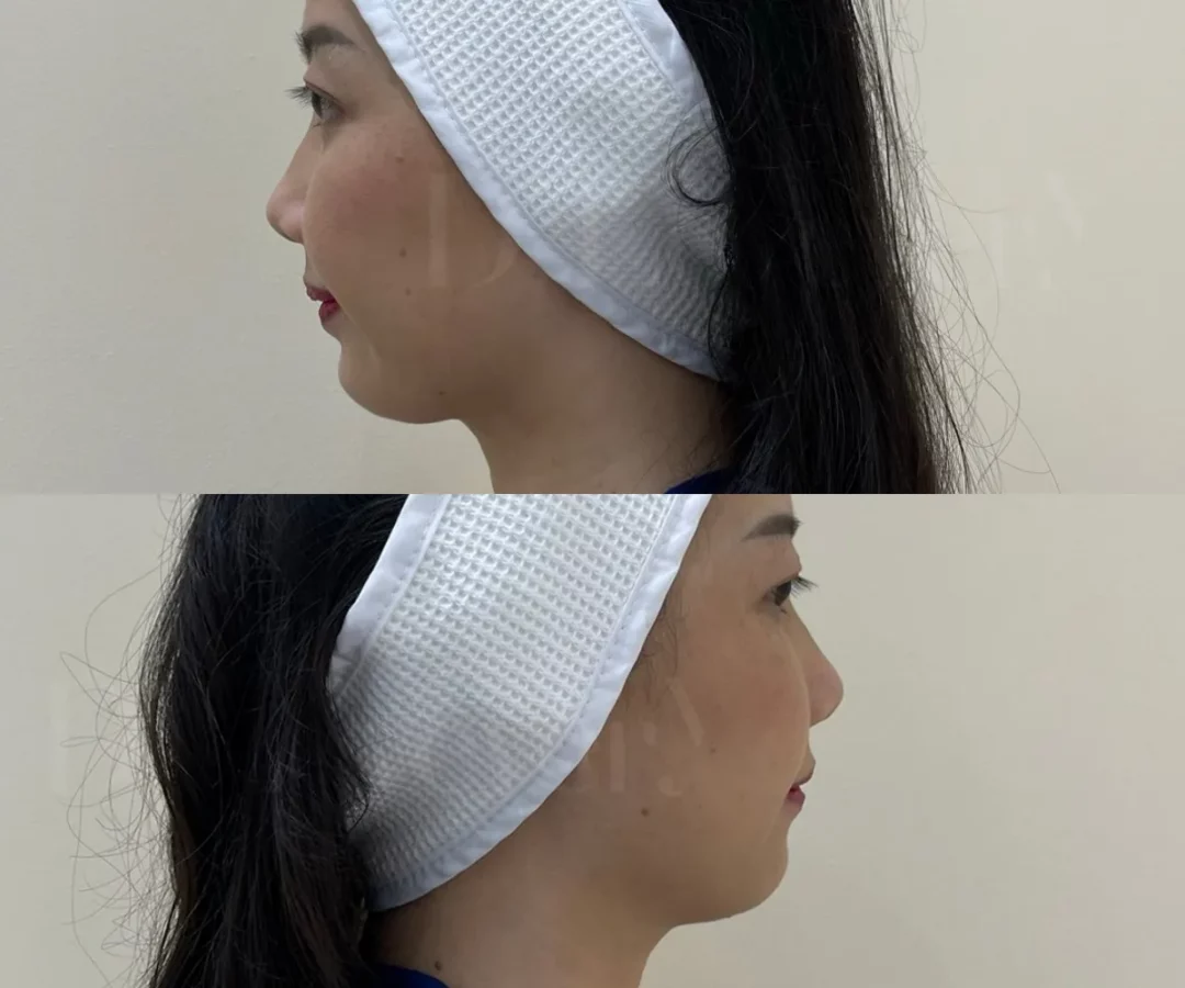 รีวิวจากเคสจริง ฉีดแฟต ก่อนทำ