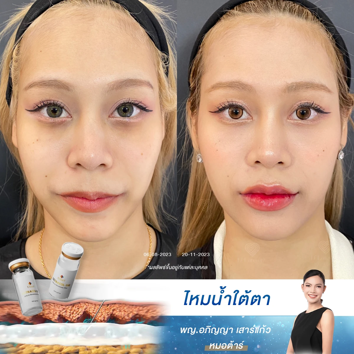 Review of under-eye thread lift using Ultracol liquid threads: Before and 2 weeks after treatment, showing full results.