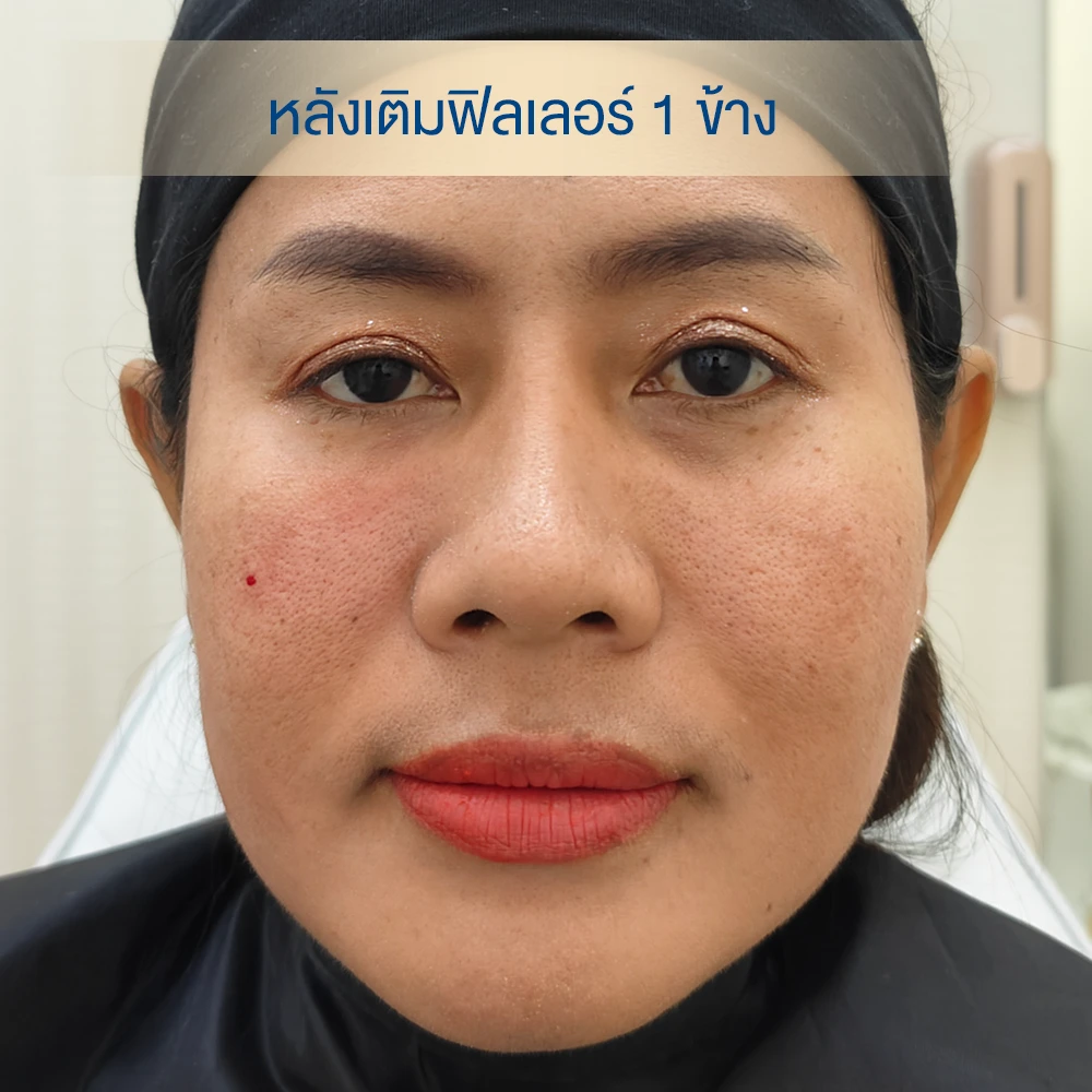 รีวิวฟิลเลอร์ใต้ตา อายุ 50 ใต้ตาคล้ำลึก dlovevery clinic ฉีดใต้ตาไปแล้ว 1 ข้าง