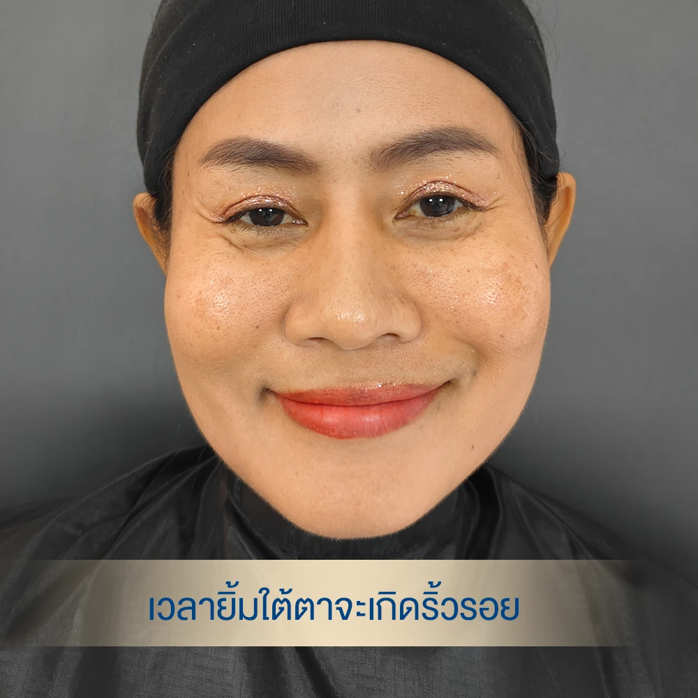 รีวิวฟิลเลอร์ใต้ตา อายุ 50 ใต้ตาคล้ำลึก dlovevery clinic ยิ้มแล้วใต้ตาลึก