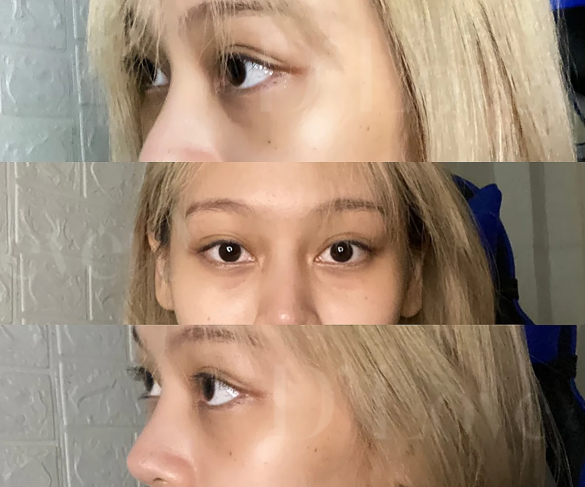 รีวิวไหมน้ำใต้ตา ช่วยวัยรุ่นฟื้นคืนใต้ตาใส ปลอดภัยไม่ง้อฟิลเลอร์ วันก่อนมารับบริการ