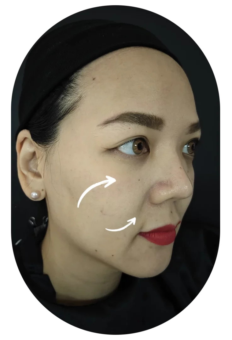 Case review 67: Filler injection for nasolabial folds and flat cheeks.