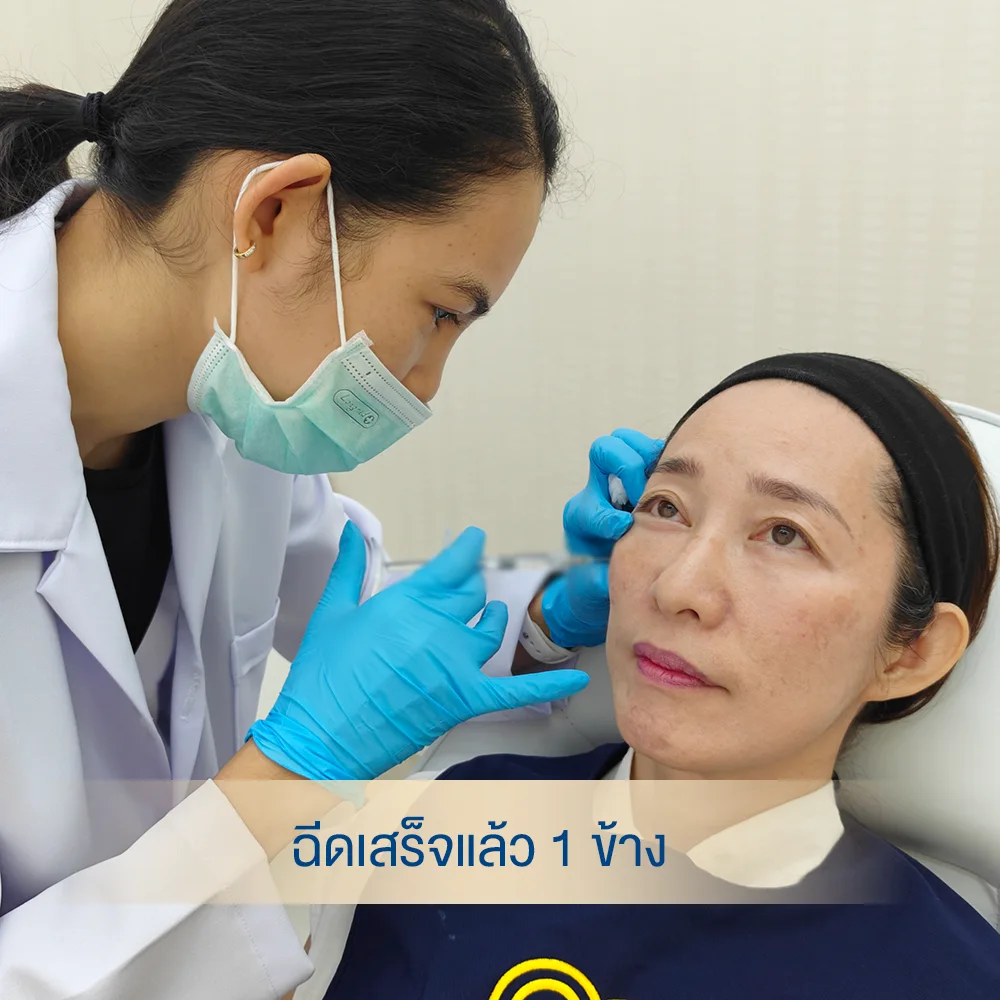 เติมฟิลเลอร์ใต้ตา เปลี่ยนชีวิต เติมความสดใสให้ดวงตา ดูเด็กลงในทันที-2